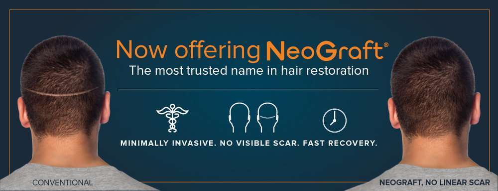 Now Offer Neograft Website Banner