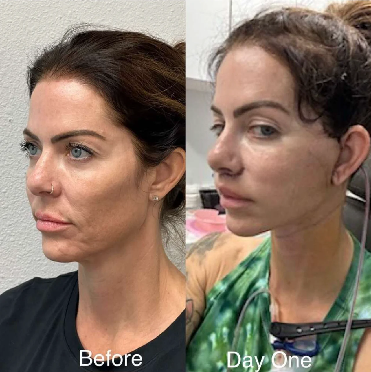 Day One Facelift Recovery Before And After