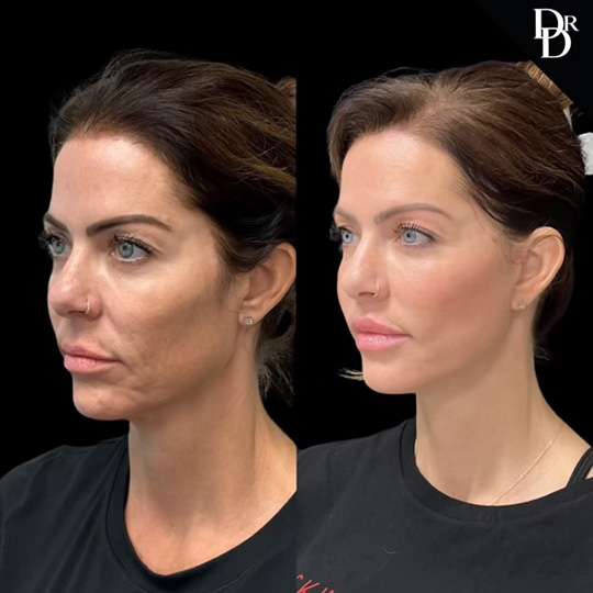 Facelift Before And After