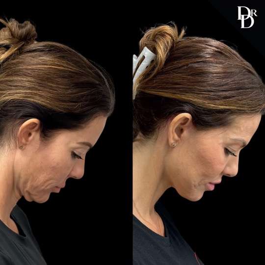 Facelift Before And After