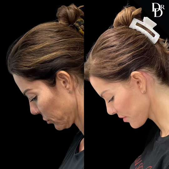 Facelift Before And After