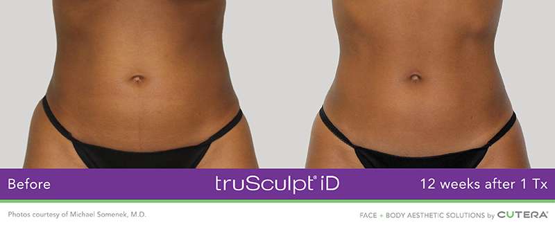 Trusculpt Before After