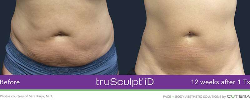 Trusculpt Before After