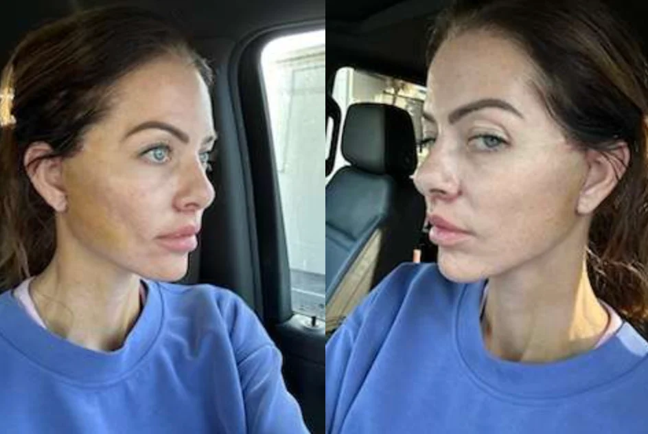 Woman With Less Swelled Face On Day After Facelift Surgery