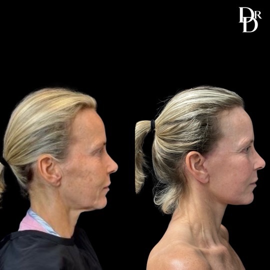 Facelift Before And After Photos By Dr. Demetri Arnaoutakis In Tampa, Fl