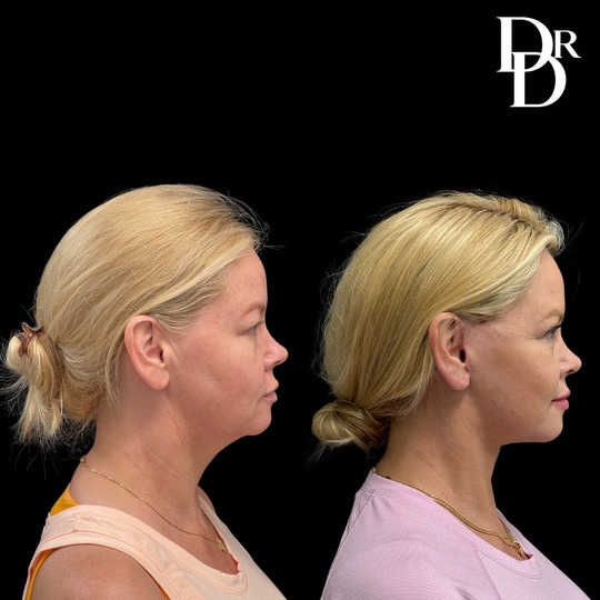 Facelift Before And After Photos By Dr. Demetri Arnaoutakis In Tampa, Fl