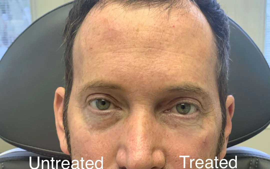 Injectable/Dermal Fillers Before And After Photos By Dr. Demetri Arnaoutakis In Tampa, Fl
