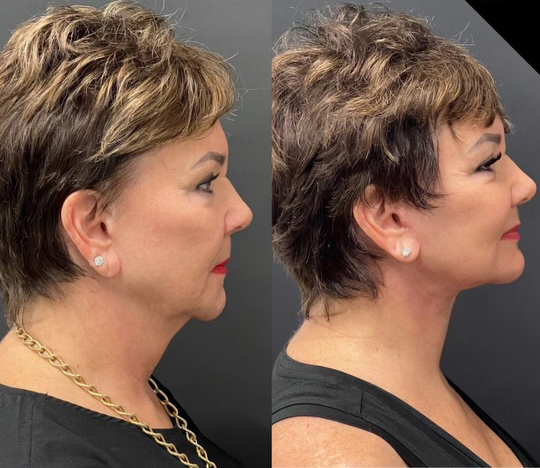 Facelift Before And After Photos By Dr Demetri Arnaoutakis In Tampa Fl Facelift Before And After Photos By Dr Demetri Arnaoutakis In Tampa Fl
