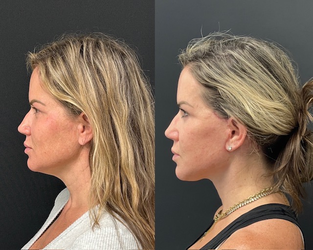 Face And Neck Lift Before And After Photos By Dr. Demetri Arnaoutakis In Tampa, Fl
