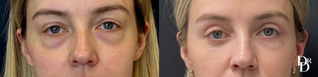 Eyelid Surgery before and after photos by Dr. Demetri Arnaoutakis in Tampa, FL