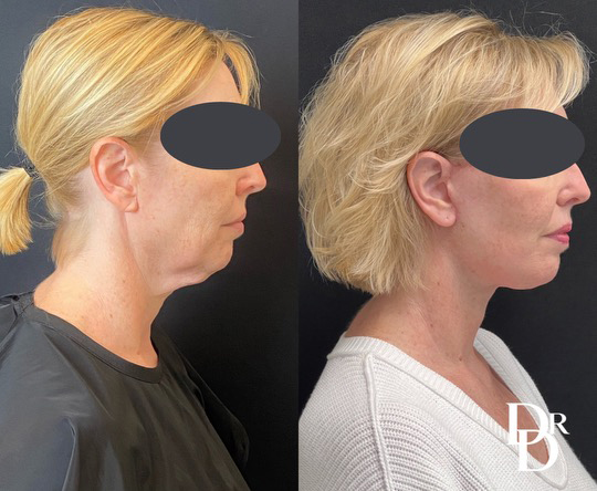 Face And Neck Lift Before And After Photo By Dr. Demetri In Beverly Hills California