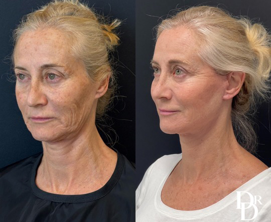 Facelift Before And After Photo By Dr. Demetri In Beverly Hills California