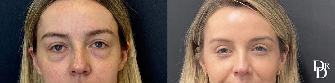 Upper & Lower Blepharoplasty before and after photos by Dr. Demetri Arnaoutakis in Tampa, FL