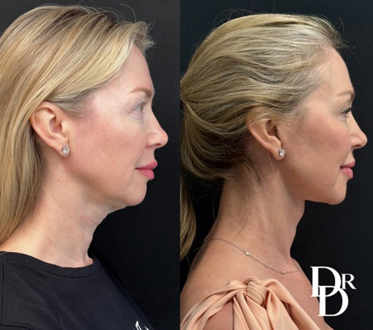 Facelift Before And After Photos By Dr. Demetri Arnaoutakis In Tampa, Fl