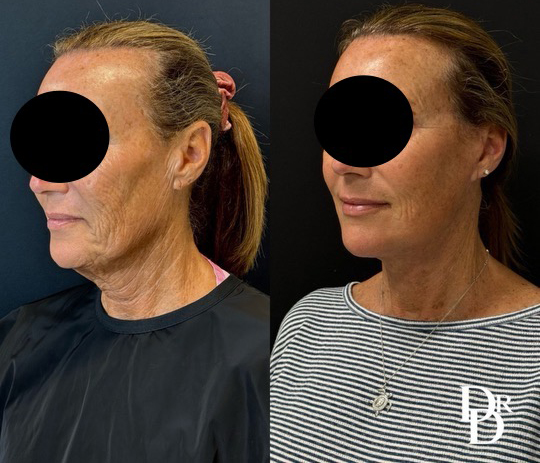 Facelift Before And After Photos By Dr. Demetri Arnaoutakis In Tampa, Fl