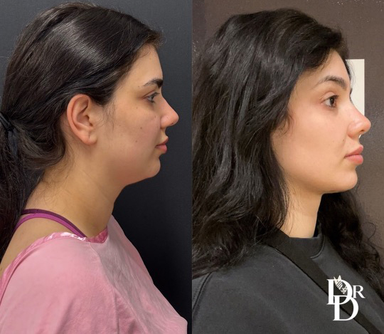 Neck Lift before and after photos by Dr. Demetri Arnaoutakis in Tampa, FL