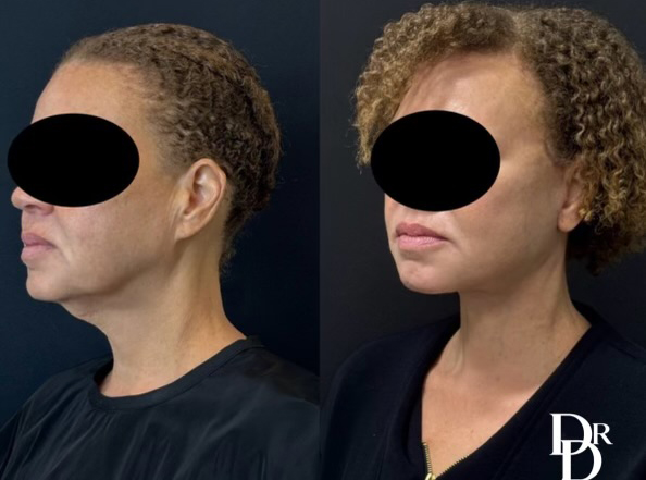 Face And Neck Lift Before And After Photo By Dr. Demetri In Beverly Hills California