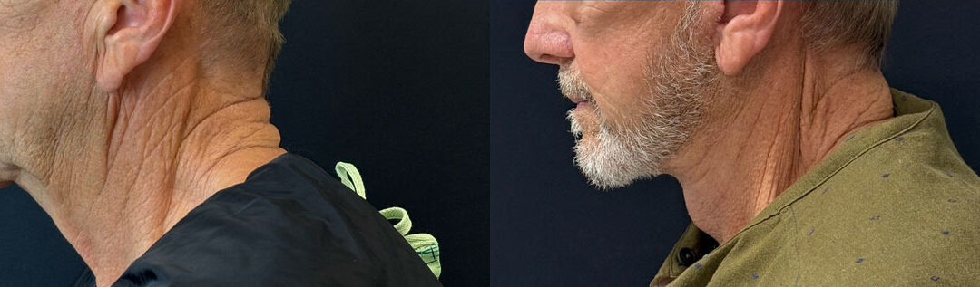 Face And Neck Lift Before And After Photo By Dr. Demetri In Beverly Hills California