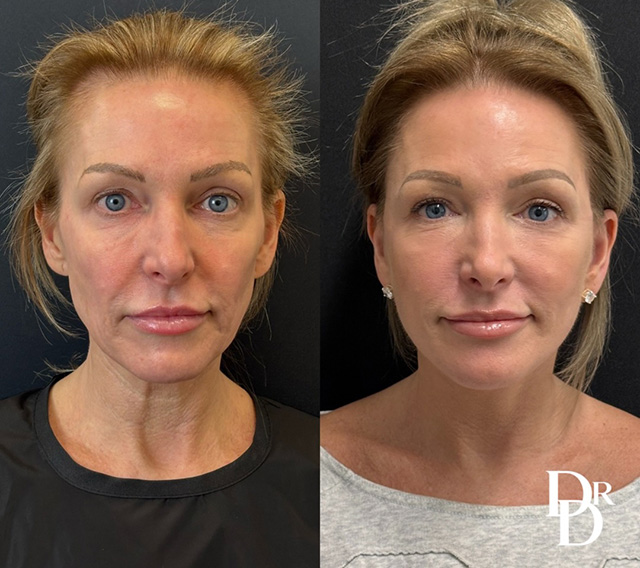 Facelift Before And After Photo By Dr. Demetri In Beverly Hills, Ca