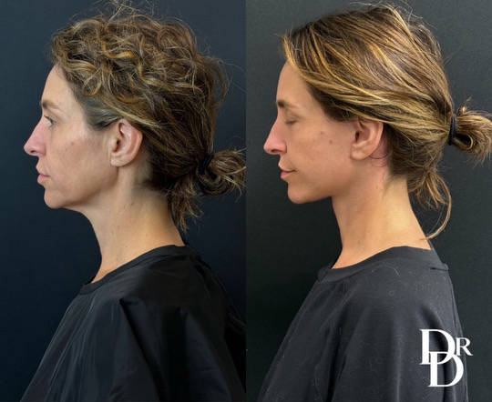 Facelift Before And After Photo By Dr. Demetri In Beverly Hills California