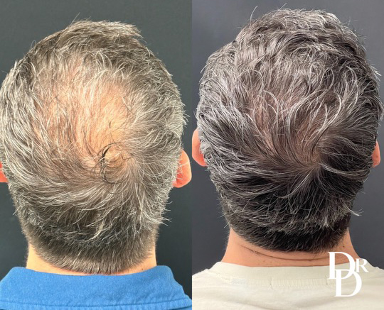 Hair Transplant Before And After Photo By Dr. Demetri In Beverly Hills California