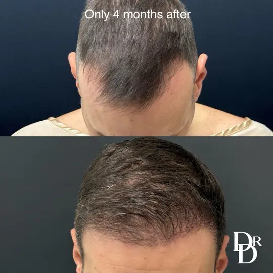 Hair Restoration