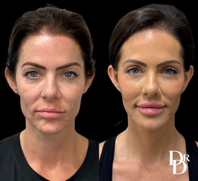 Blepharoplasty &Amp; Lip Lift Before And After Photo By Dr. Demetri In Beverly Hills, Ca