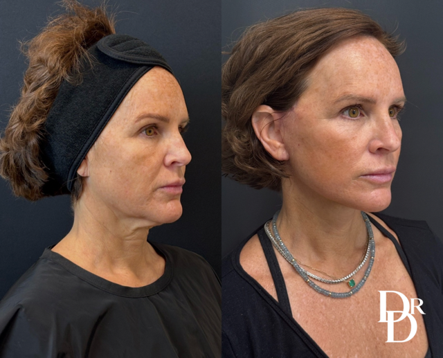Facelift Before And After Photo By Dr. Demetri In Beverly Hills, Ca