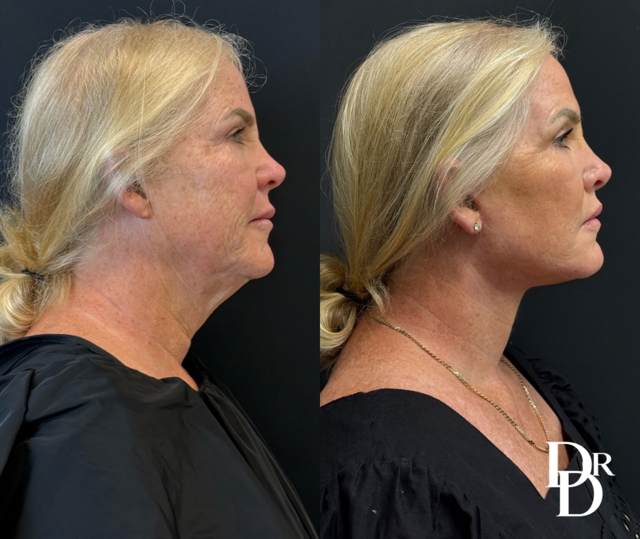 Facelift Before And After Photos By Dr. Demetri Arnaoutakis In Tampa, Fl