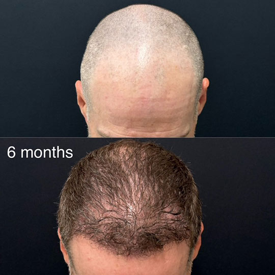 Hair Transplant Before And After Photos By Dr. Demetri Arnaoutakis In Tampa, Fl