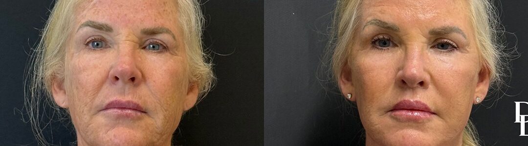 Lip Lift Before And After Photos By Dr. Demetri Arnaoutakis In Tampa, Fl