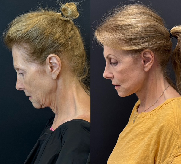 Facelift Before And After Photos By Dr. Demetri Arnaoutakis In Tampa, Fl