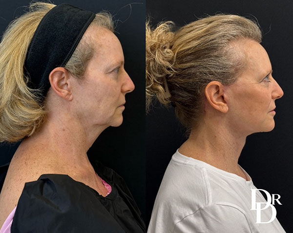 Facelift Before And After Photos By Dr. Demetri Arnaoutakis In Tampa, Fl
