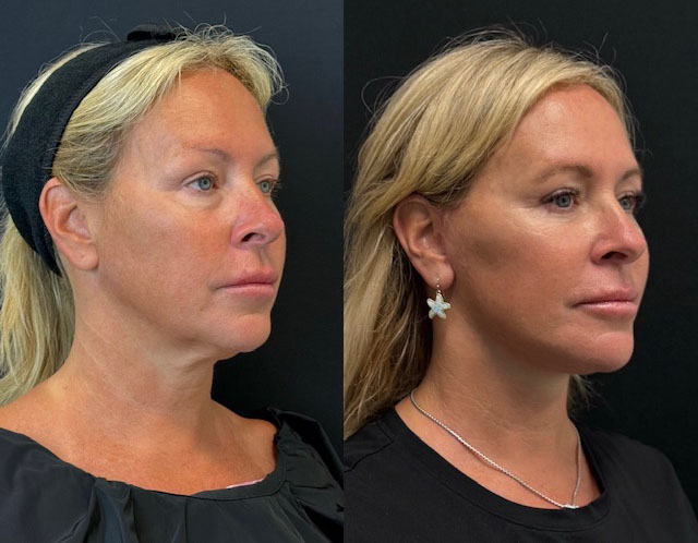 Facelift Before And After Photos By Dr. Demetri Arnaoutakis In Tampa, Fl