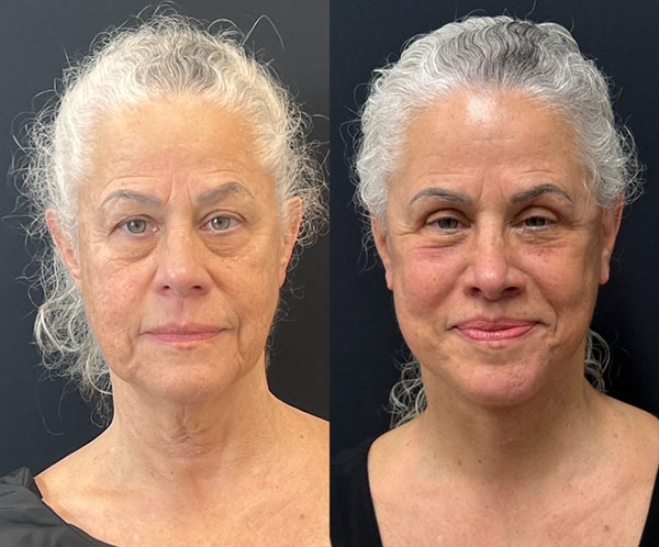 Facelift Before And After Photos By Dr. Demetri Arnaoutakis In Tampa, Fl