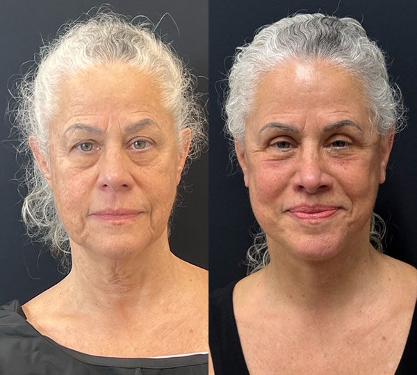Lip Lift Before And After Photos By Dr. Demetri Arnaoutakis In Tampa, Fl