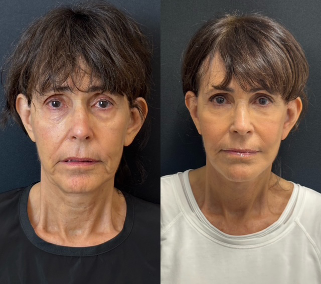 Facelift And Lower Blepharoplasty Before And After Photos By Dr. Demetri Arnaoutakis In Tampa, Fl