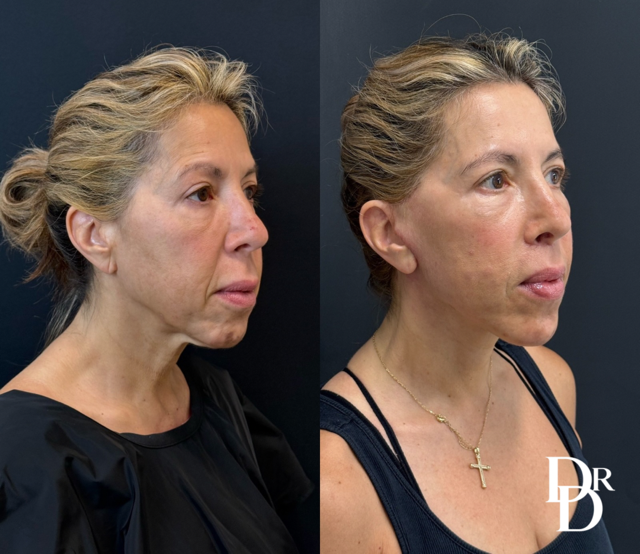 Facelift Before And After Photos By Dr. Demetri Arnaoutakis In Tampa, Fl