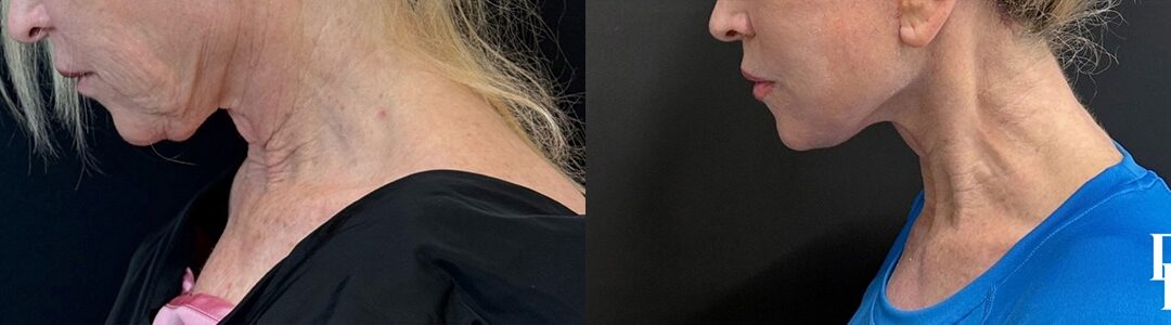 Neck Lift Before And After Photos By Dr. Demetri Arnaoutakis In Tampa, Fl