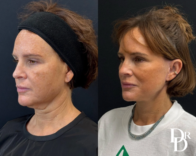Necklift Before And After Photos By Dr. Demetri Arnaoutakis In Tampa, Fl