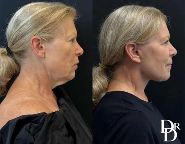 Neck And Facelift Before And After Photos By Dr. Demetri Arnaoutakis In Tampa, Fl