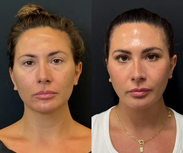 Front View Lower Blepharoplasty Before And After Photos By Dr. Demetri Arnaoutakis In Tampa, Fl