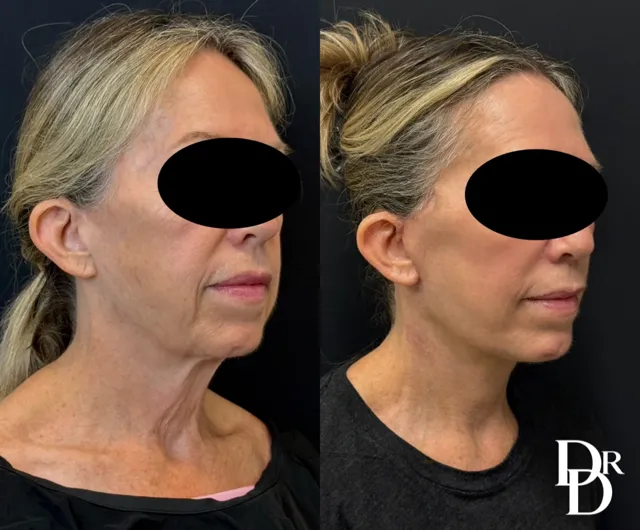 Right Oblique View Facelift Before And After Photos By Dr. Demetri Arnaoutakis In Tampa, Fl