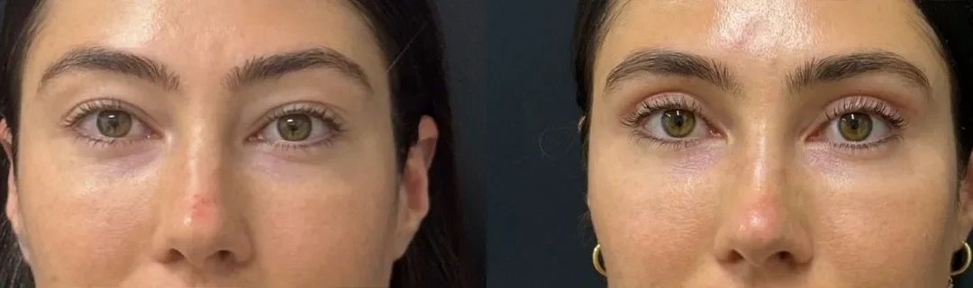 Upper Blepharoplasty Before And After Photos By Dr. Demetri Arnaoutakis In Tampa, Fl