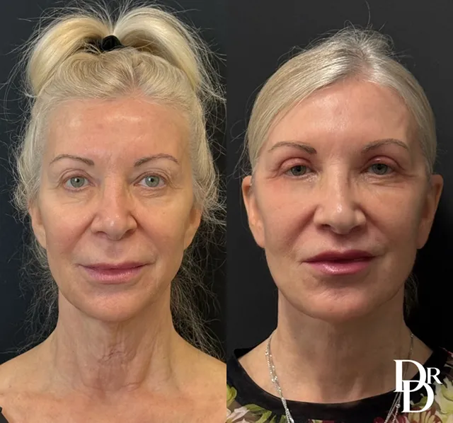 Front View Facelift Before And After Photos By Dr. Demetri Arnaoutakis In Tampa, Fl