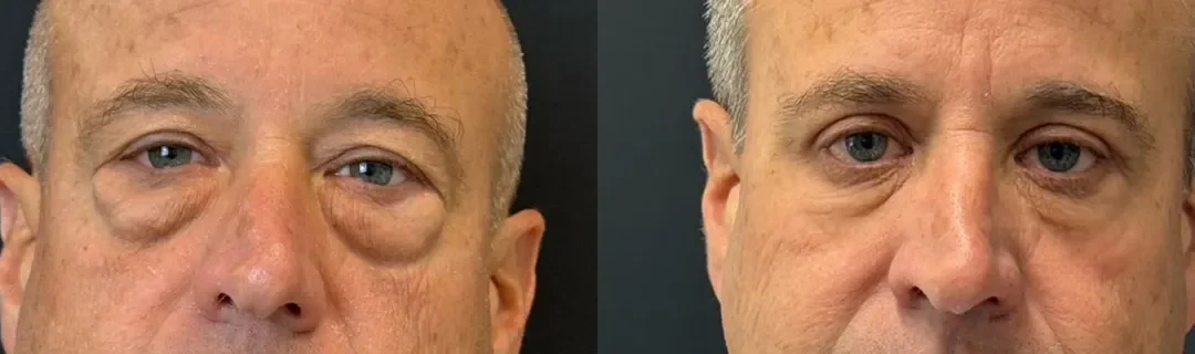 Front View Upper &Amp; Lower Bleph Before And After Photos By Dr. Demetri Arnaoutakis In Tampa, Fl