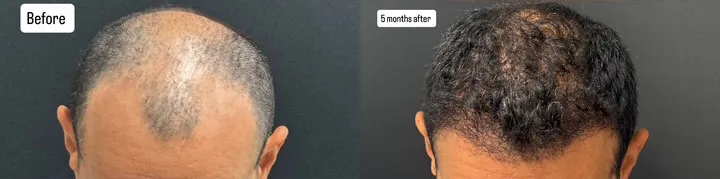 Hair Transplant Before And After Photos By Dr. Demetri Arnaoutakis In Tampa, Fl