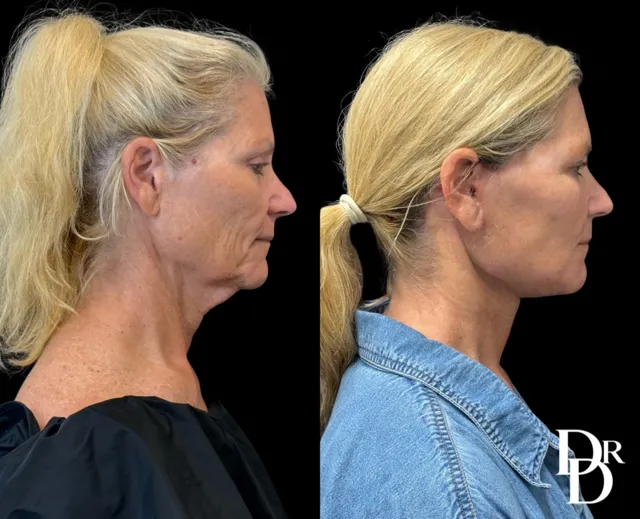 Side View Facelift Before And After Photos By Dr. Demetri Arnaoutakis In Tampa, Fl