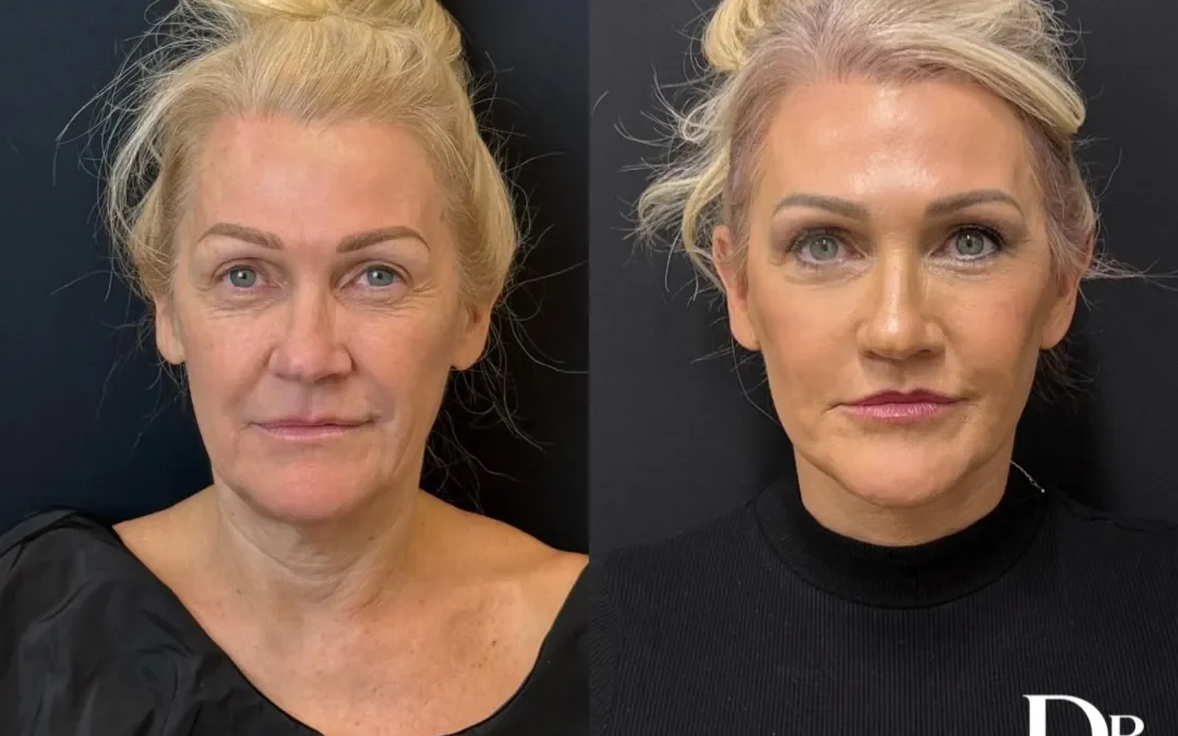 Front View Facelift Before And After Photos By Dr. Demetri