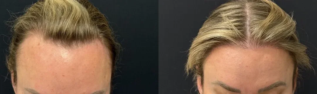 Front View Hair Transplant Before And After Photos By Dr. Demetri